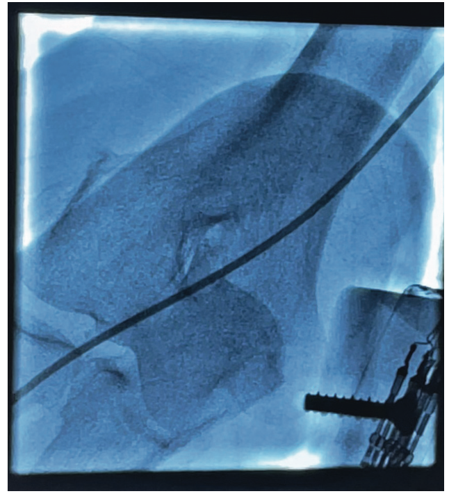 Kinked Catheter Unravelment in the Right Upper Extremity An Unconventional Solution